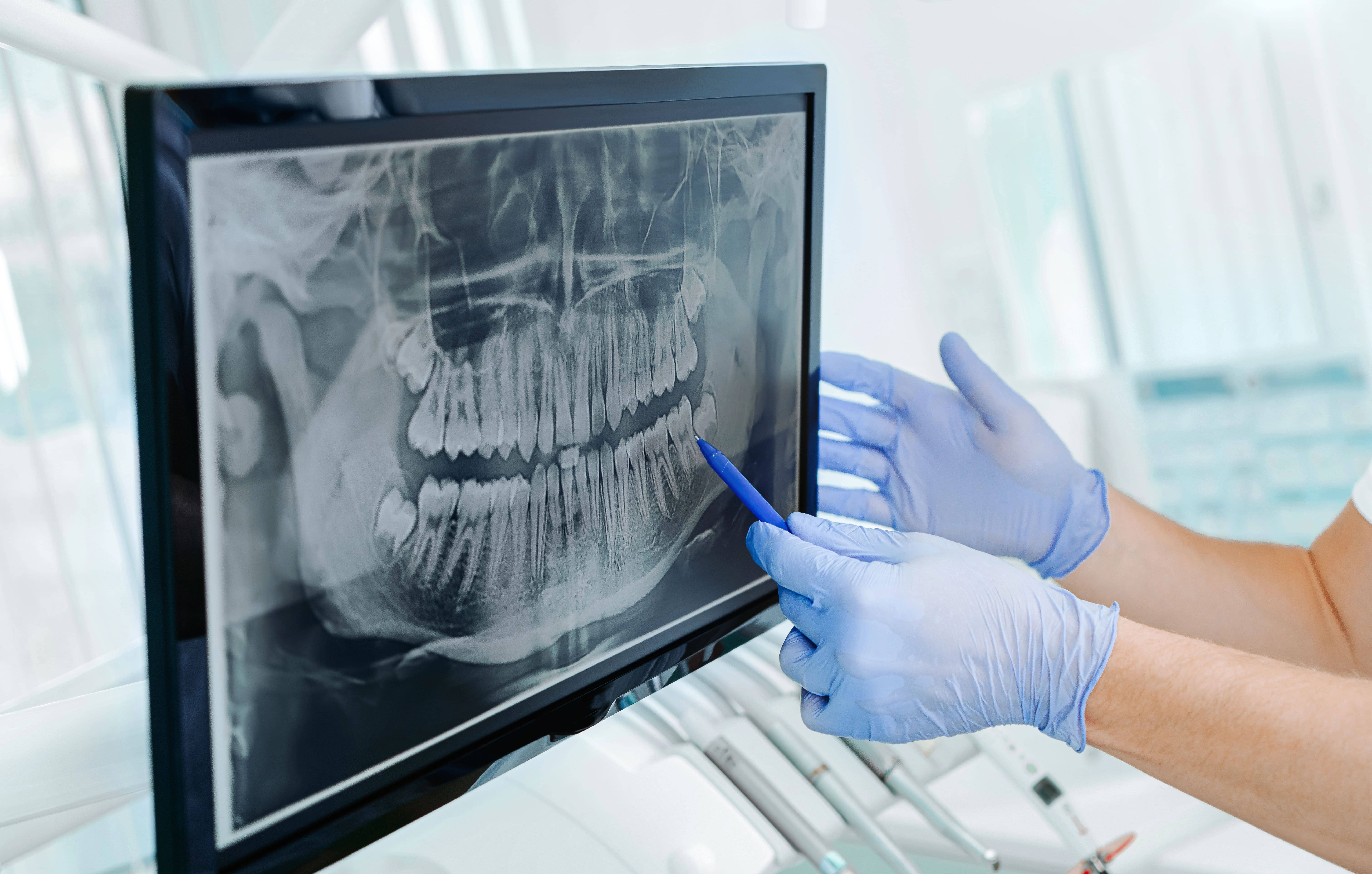 Dental X-ray before dental implant placement at Artistic Dentistry in Santa Monica