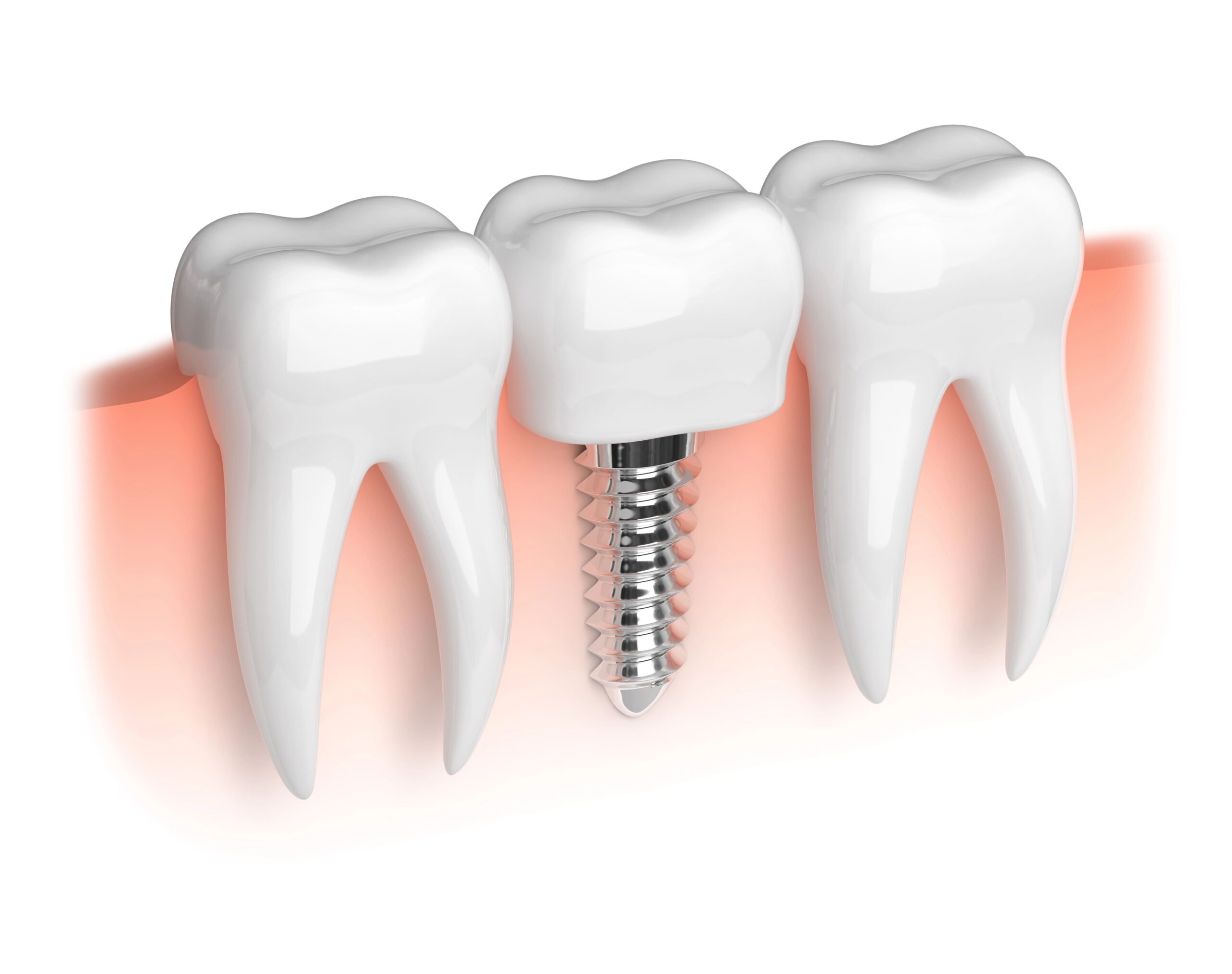 Dental implant with titanium post and custom crown at Artistic Dentistry in Santa Monica