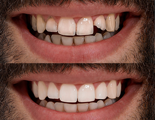 Before and after dental implant treatment at Artistic Dentistry in Santa Monica